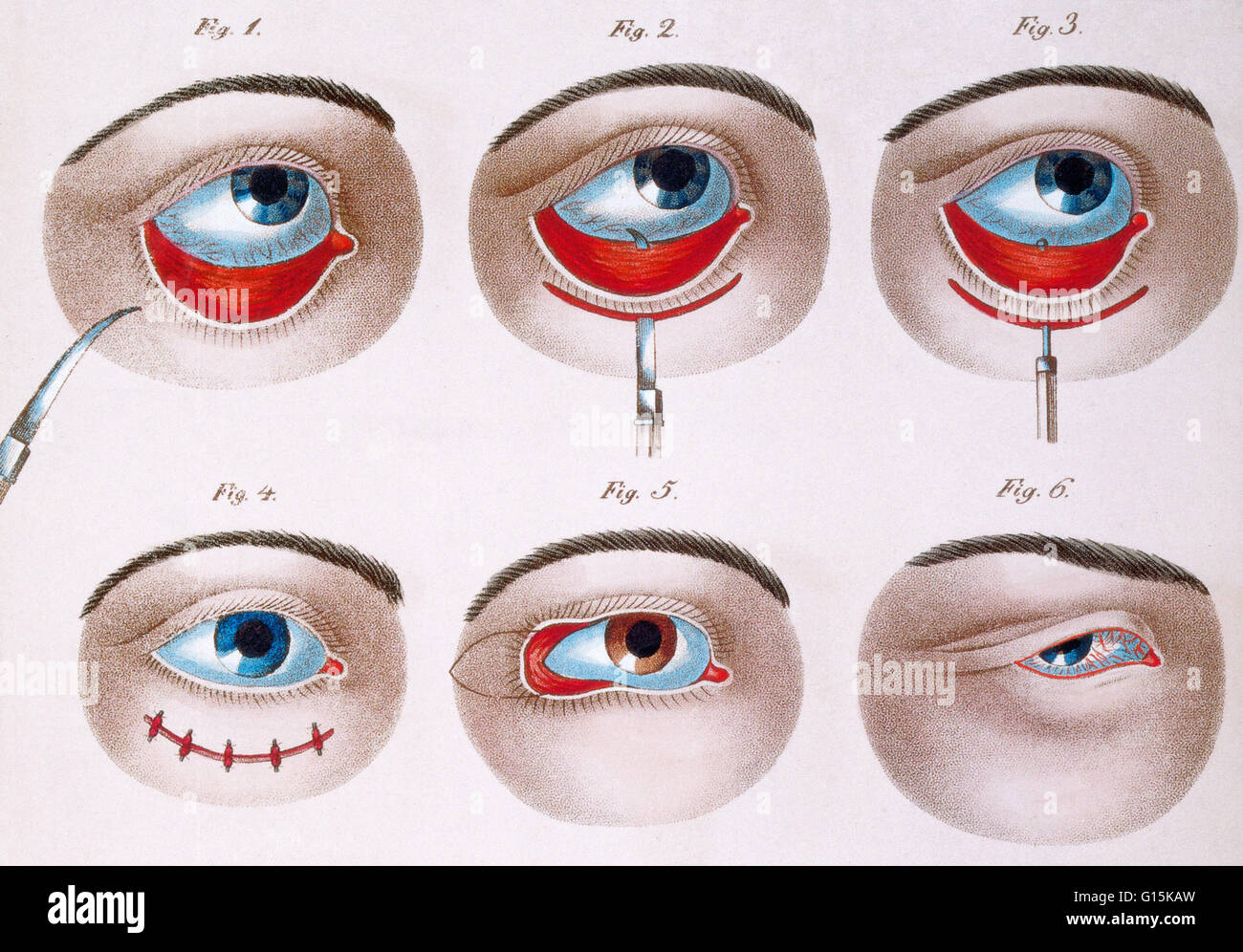 Darstellung des chirurgischen Eingriffs, eine faule untere Augenlid (Ptosis), c. 1830 zu korrigieren. Ptose ist eine hängende oder fallen von der oberen oder unteren Augenlid. Die herabhängenden möglicherweise schlimmer nach mehr, wach sein, wenn die einzelnen Muskeln müde sind. Dieses c Stockfoto