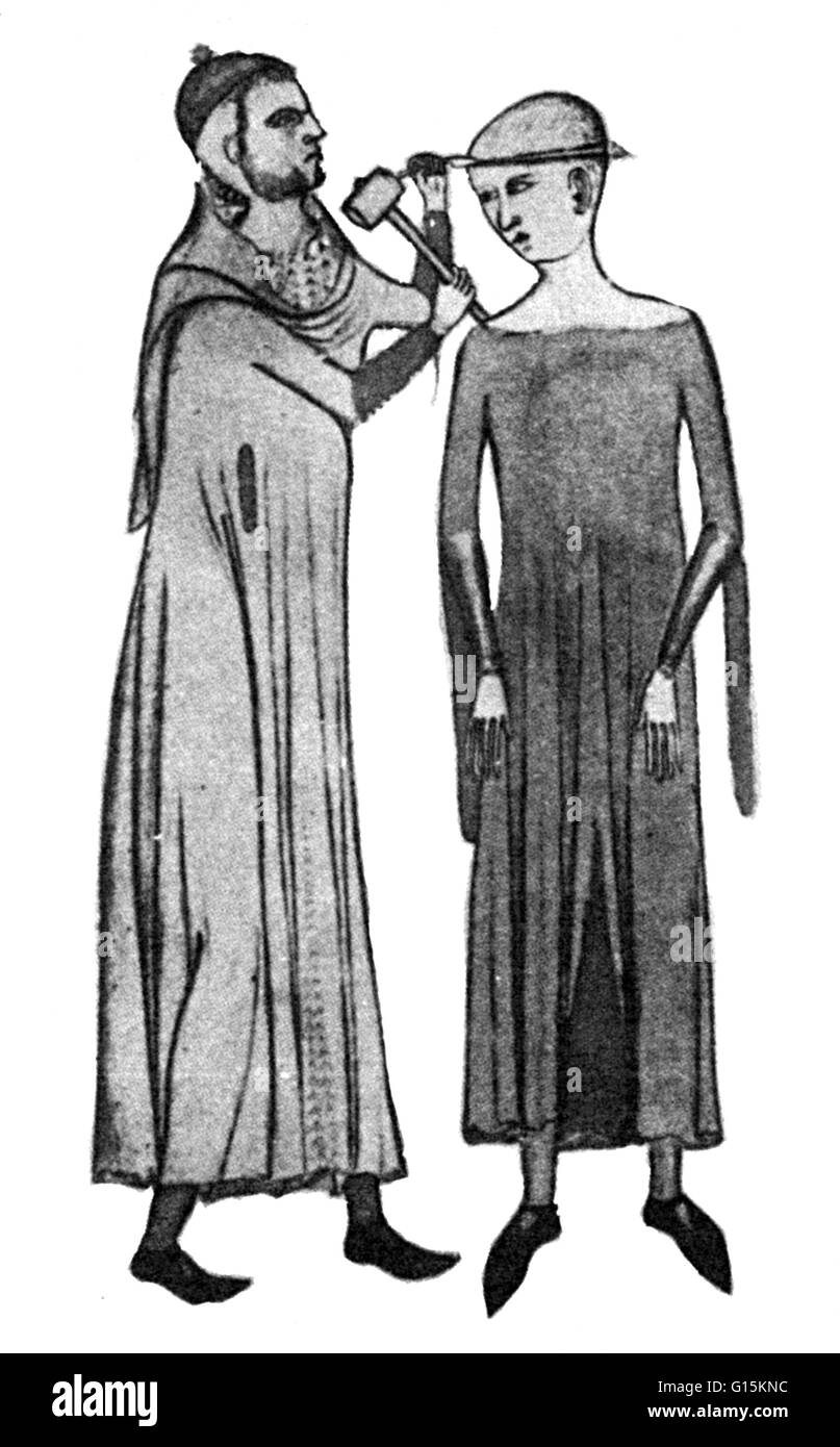 Zerspant Holzschnitt von Guiso de Vigevano Anatomia, 1345. Fräserdurchmesser ist ein chirurgischer Eingriff, in dem ein Loch gebohrt oder geschabt in den menschlichen Schädel, Freilegung der Dura Mater, gesundheitliche Probleme im Zusammenhang mit intrakraniellen Erkrankungen zu behandeln. Höhlenmalereien Stockfoto