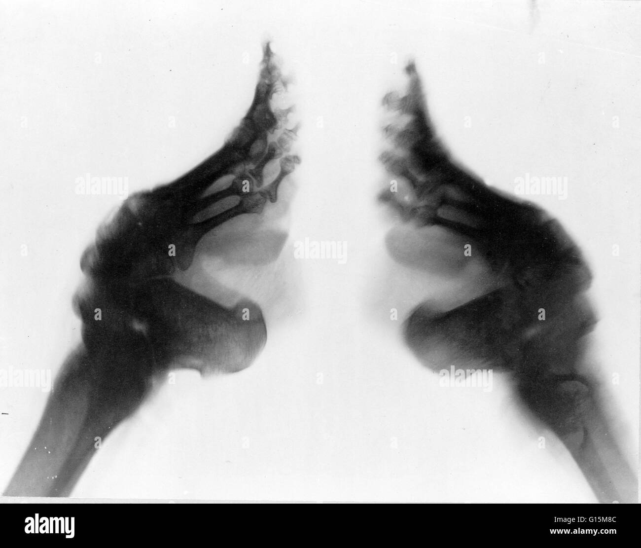 X-ray gefesselten Füße, China, zwischen 1890 und 1923. Fußbindens war der Brauch der Bindung die Füße junger Mädchen schmerzhaft fest, um weiteres Wachstum zu verhindern. Die kleine schmale Füße wurden als schön und machen eine Frau Bewegungen mehr feminin und d Stockfoto