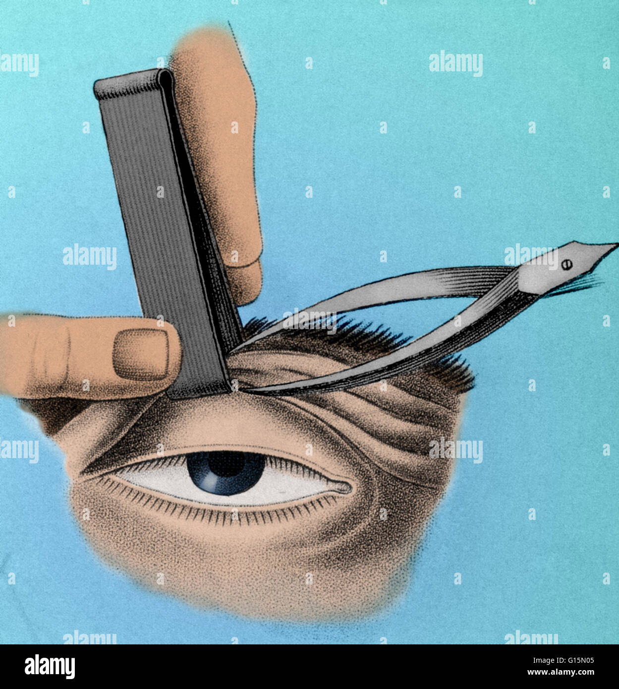 Abbildung zeigt den chirurgischen Eingriff zu korrigieren, eine faule Oberlid (Ptosis), um 1830. Stockfoto
