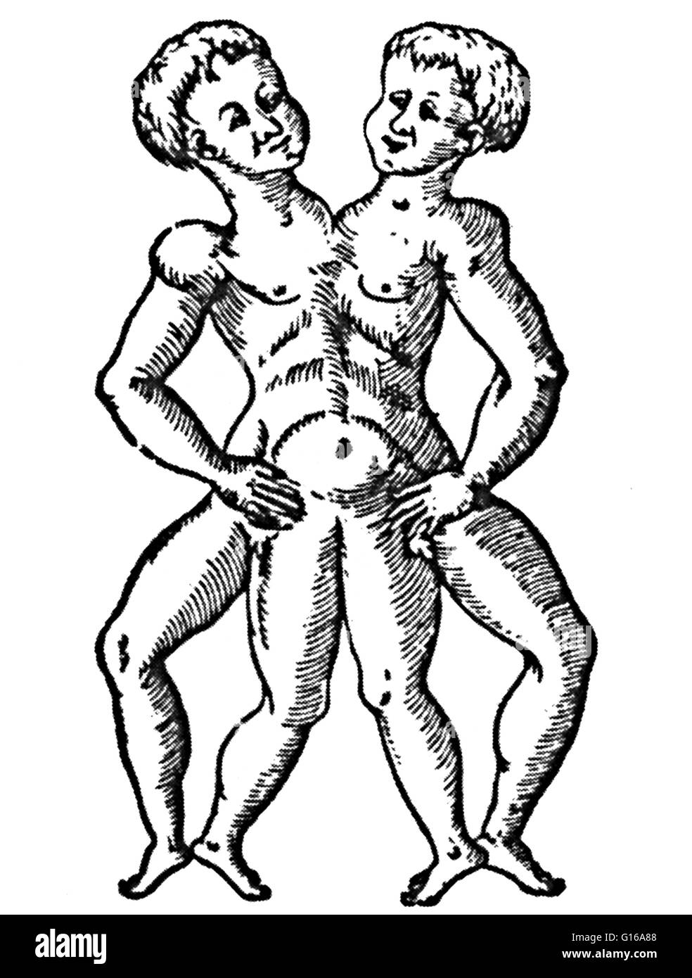 Holzschnitt der siamesische Zwillinge aus Des Monstres et Prodiges von Ambroise Paré, 1573. Siamesische Zwillinge sind eineiige Zwillinge geboren mit ihren Körpern trat zu einem bestimmten Zeitpunkt und mit unterschiedlichem Grad der restliche Doppelarbeit, ein Ergebnis der unvollständigen Teilung der Stockfoto