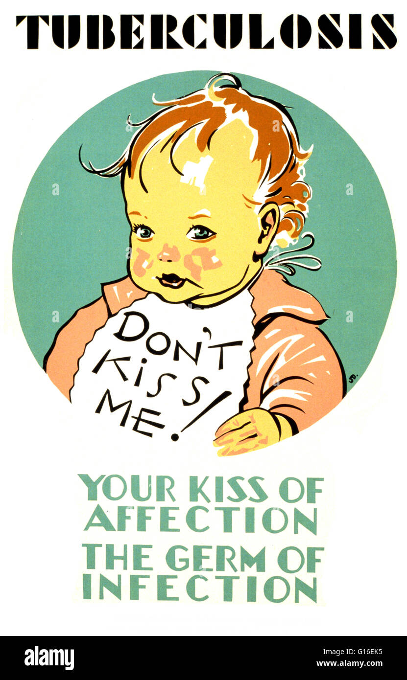 Unter dem Titel: "Tuberkulose nicht Küss mich! Dein Kuss Zuneigung - der Keim der Infektion ". Poster über Tuberkulose bei Kindern und Methoden der Übertragung zeigt ein Kind trägt ein Lätzchen. Die Federal Art Project (FAP) wurde die bildende Kunst-Arm des großen De Stockfoto