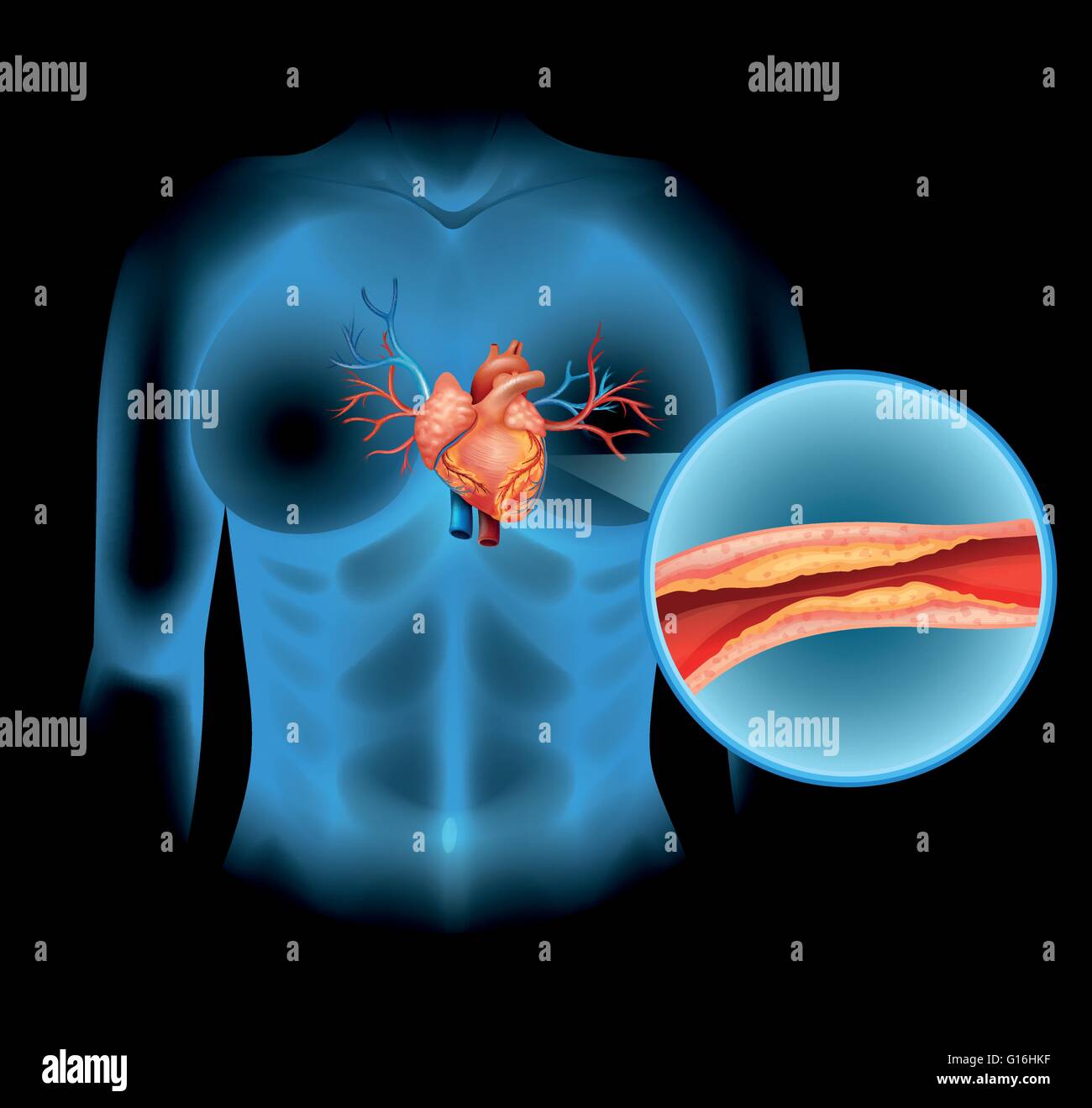 Herz-Kreislauferkrankungen verursacht durch Cholesteral illustration Stock Vektor