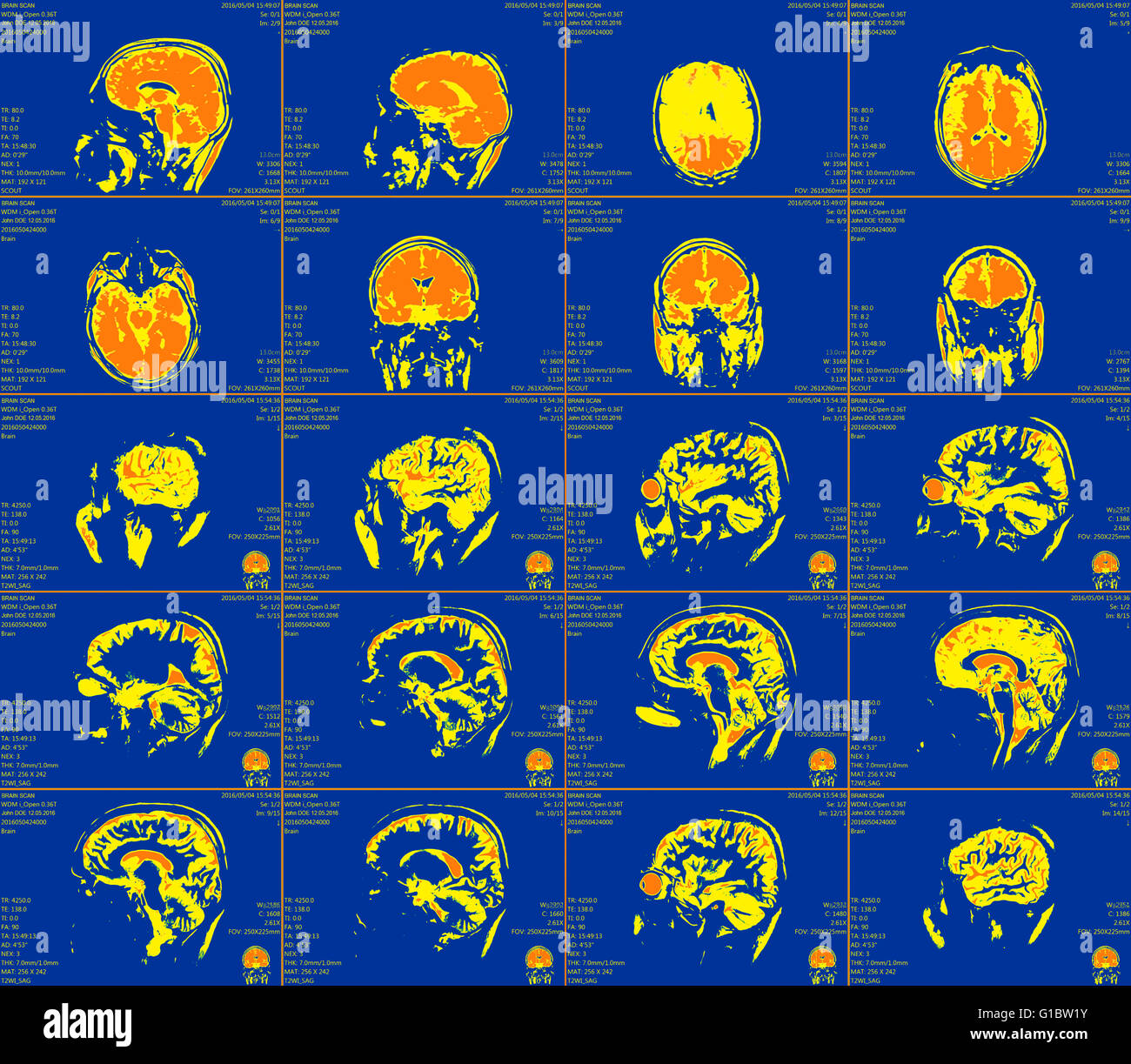 Magnetresonanz-Bildgebung des Gehirns Stockfoto