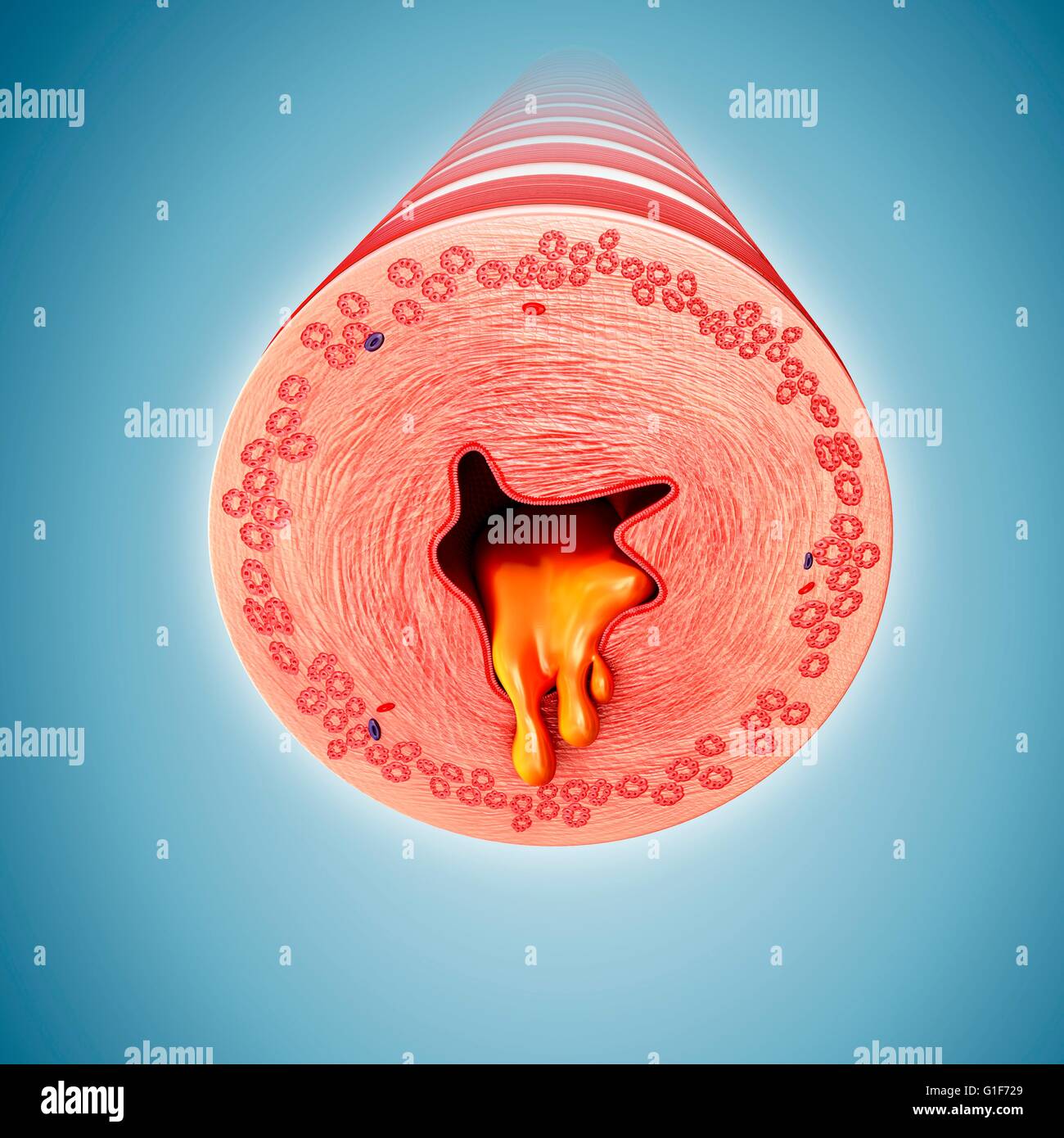 Infizierten menschlichen Bronchus der Lunge, Abbildung. Stockfoto
