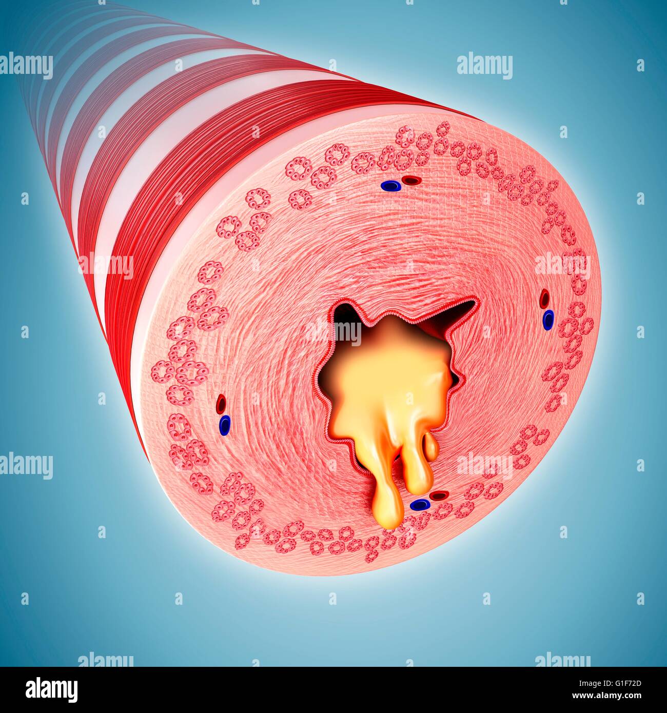 Infizierten menschlichen Bronchus der Lunge, Abbildung. Stockfoto