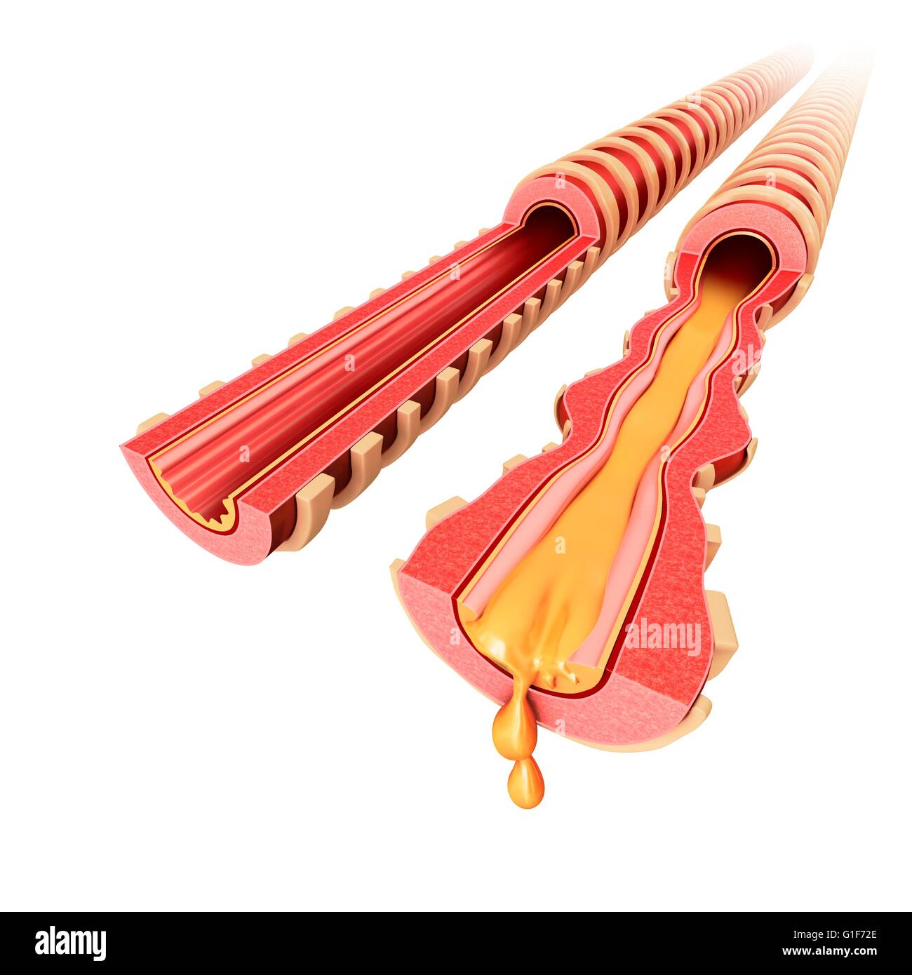 Infizierten menschlichen Bronchus der Lunge, Abbildung. Stockfoto