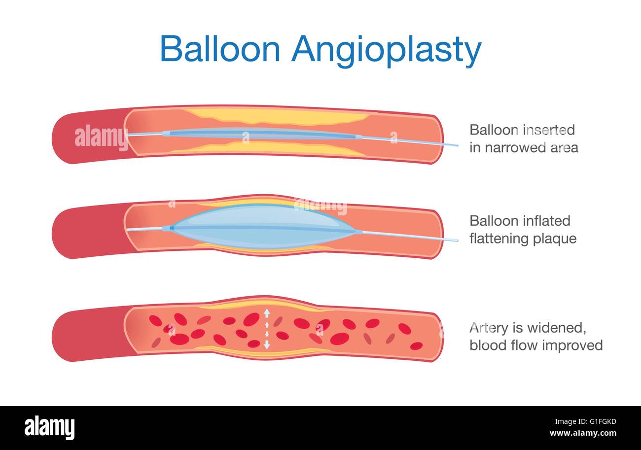 Ballon-Angioplastie-Verfahren Stock Vektor