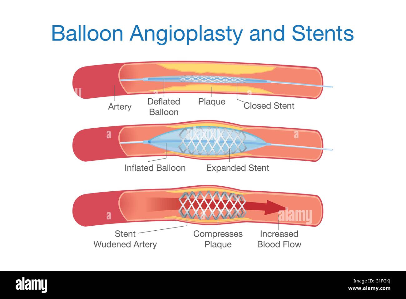 Ballon-Angioplastie und Stents-Verfahren Stock Vektor