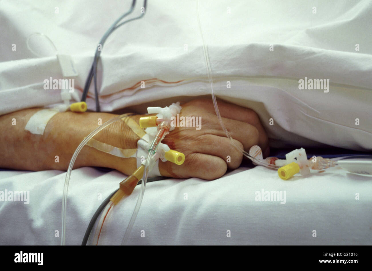 Hand des Patienten mit intravenösen Anschlüsse auf Intensivstation Stockfoto