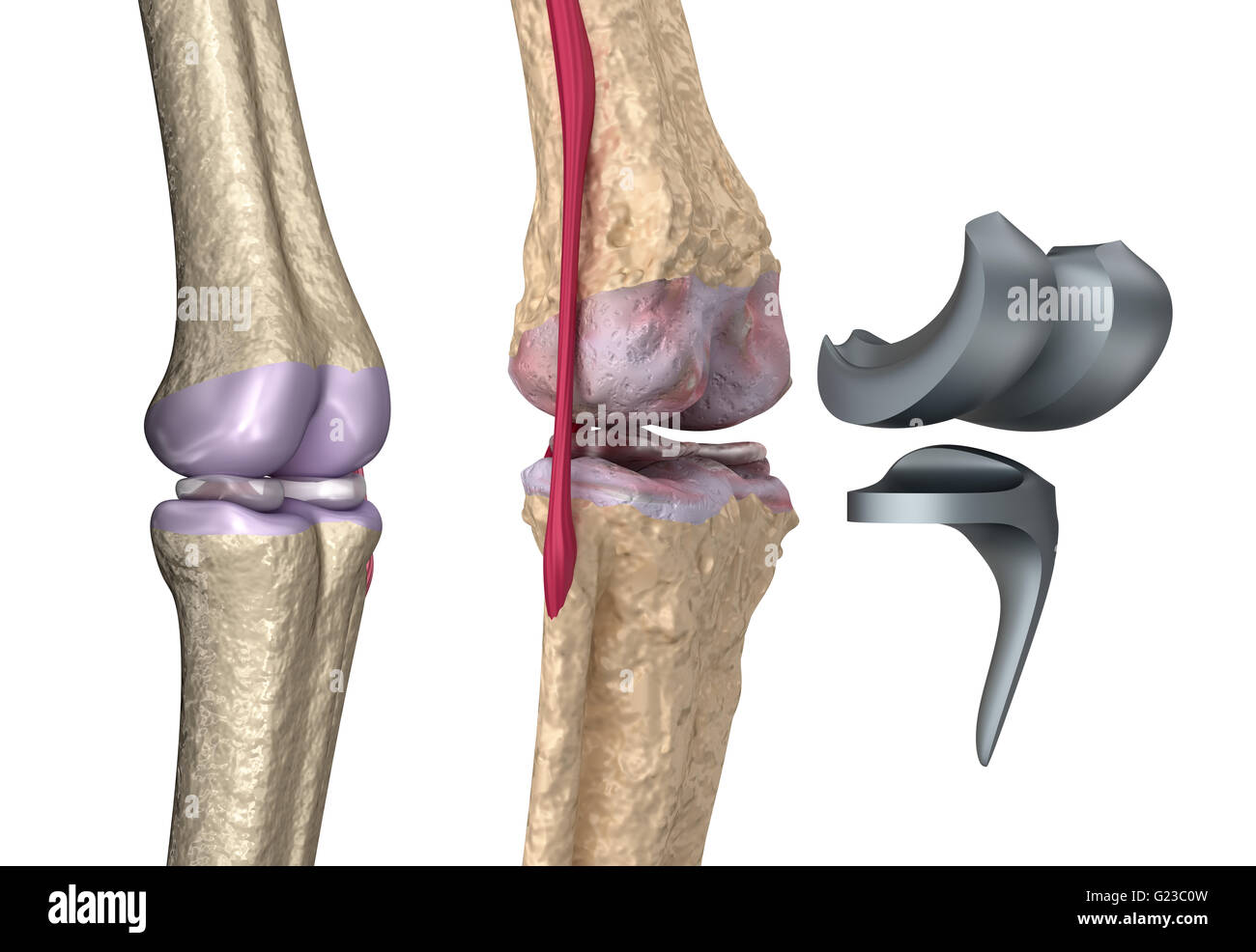 Knie und Titan Scharniergelenk. Isoliert auf weiss Stockfoto