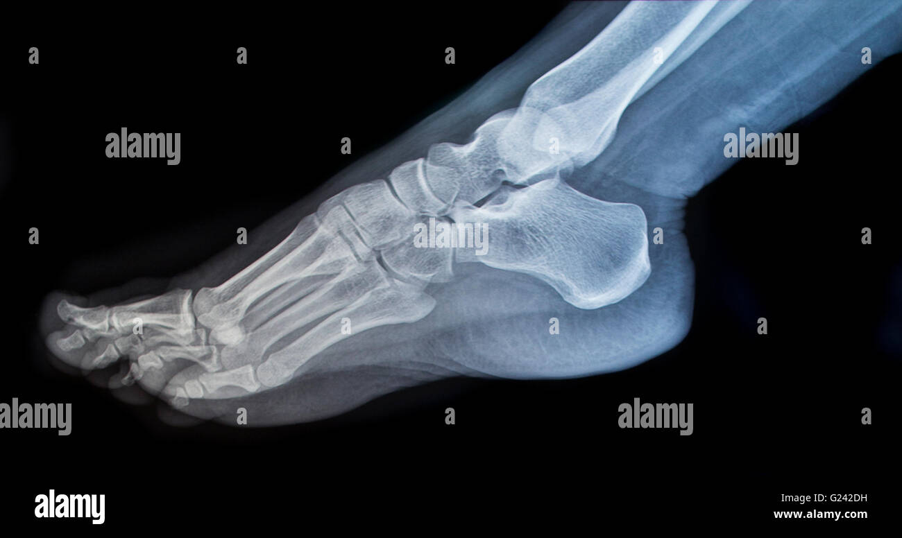 Röntgenbild eines Fußes Stockfotografie - Alamy
