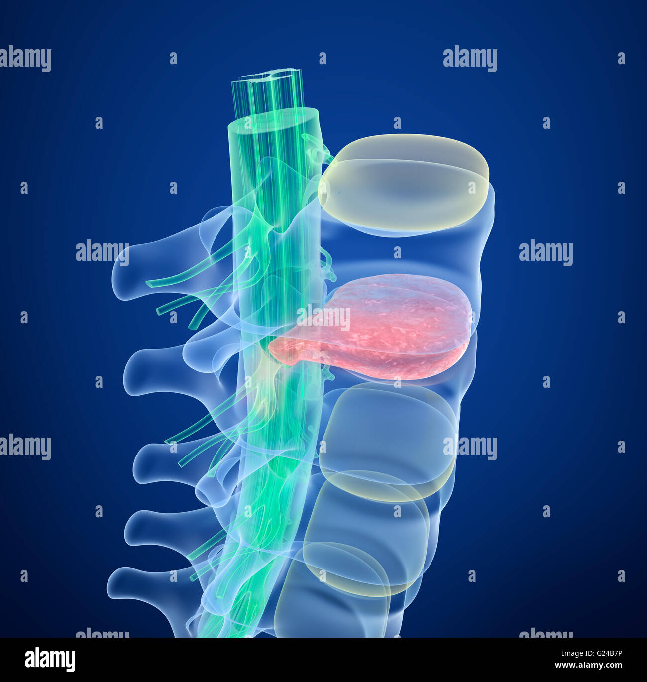 Rückenmarks unter Druck der Bandscheibenvorfall, Röntgenblick.  3D illustration Stockfoto