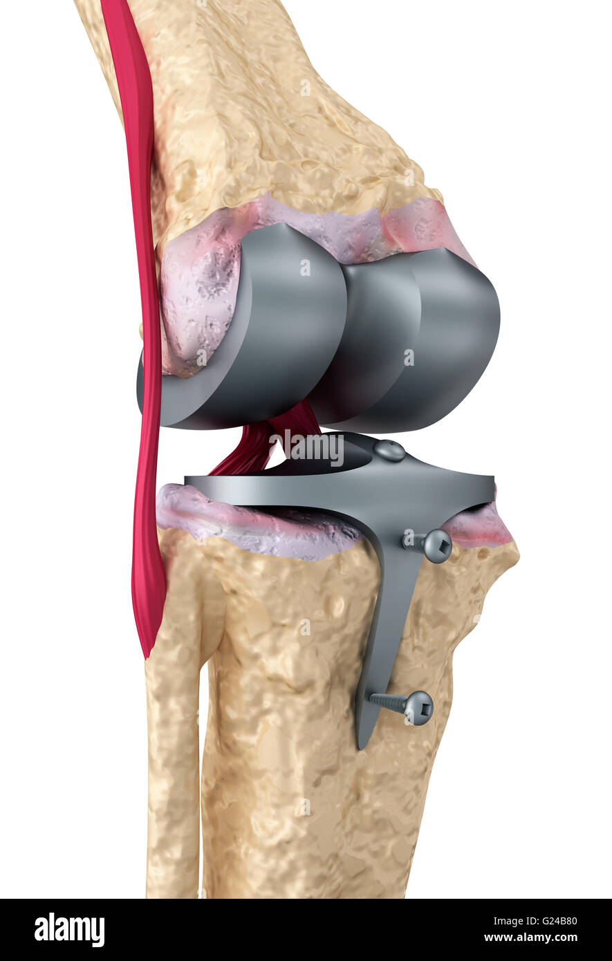 Knie und Titan Scharniergelenk. Isoliert auf weiss Stockfoto