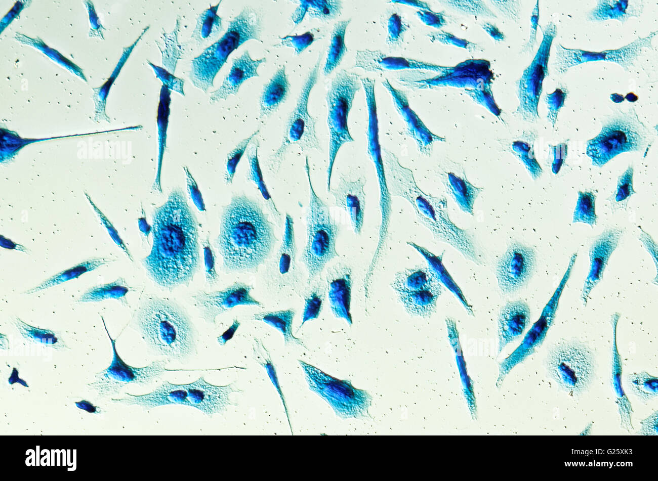 PC-3 menschlichen Prostatakrebszellen, befleckt mit Coomassie Blau, unter differen Interferenz-Kontrast-Mikroskop. Stockfoto