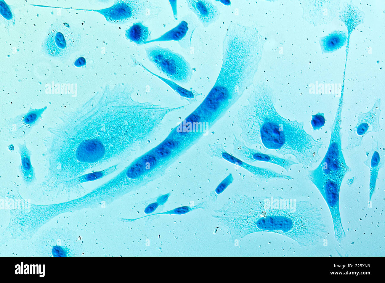 PC-3 menschlichen Prostatakrebszellen, befleckt mit Coomassie Blau, unter differen Interferenz-Kontrast-Mikroskop. Stockfoto