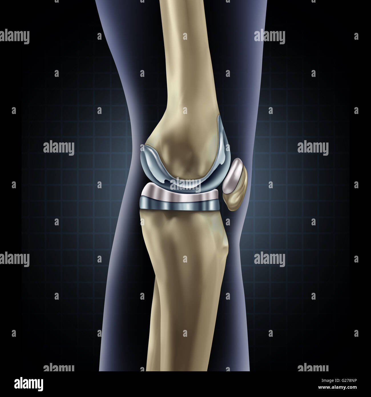Knie-TEP Implantat medizinisches Konzept als ein menschliches Bein Anatomie nach eine prothetische Chirurgie als ein Muskel-Skelett-Erkrankungen-Behandlung-Symbol für Orthopädie mit 3D Abbildung Elemente. Stockfoto