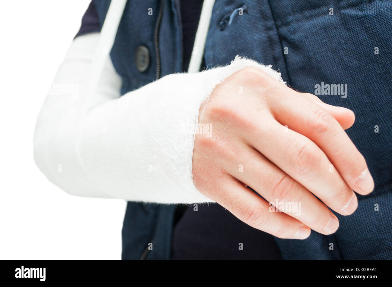 Gebrochenen Ellbogen mit medizinischer Verband oder Gips zu behandeln und die Entzündung zu verringern Stockfoto