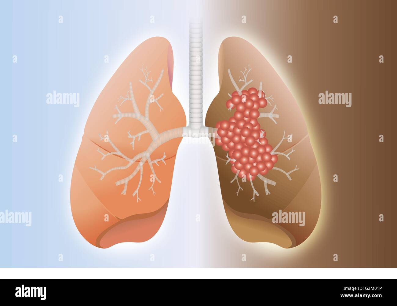 Vergleich zwischen gesunden Lunge und Krebs Lunge. Stock Vektor