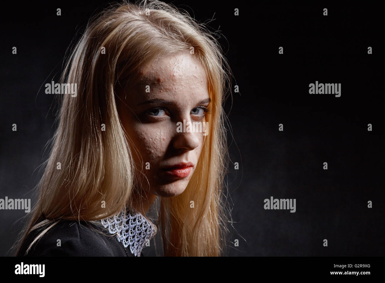 Blondes Mädchen mit pickligen Haut weinend auf schwarzem Hintergrund Stockfoto