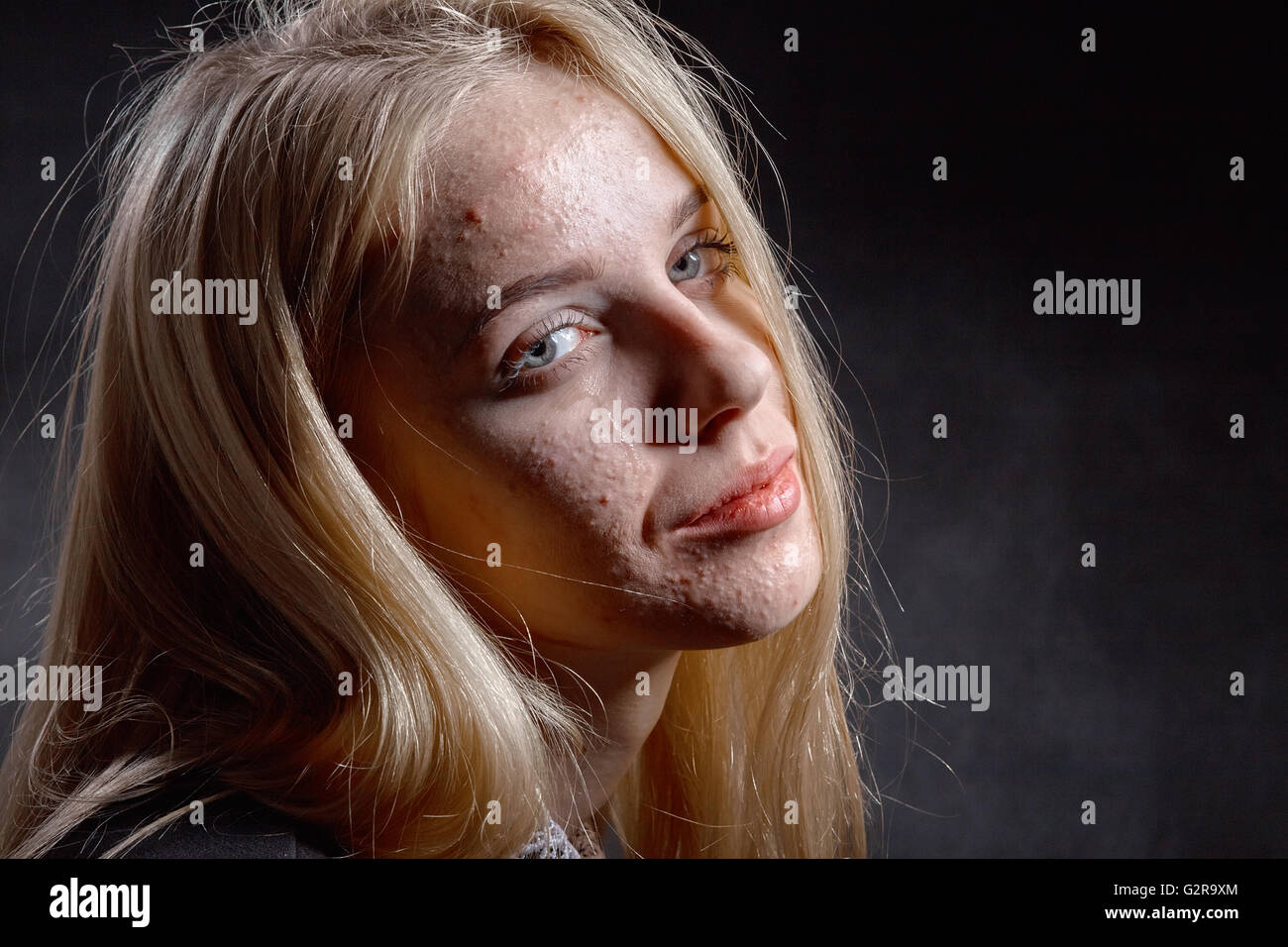 Blondes Mädchen mit pickligen Haut weinend auf schwarzem Hintergrund Stockfoto