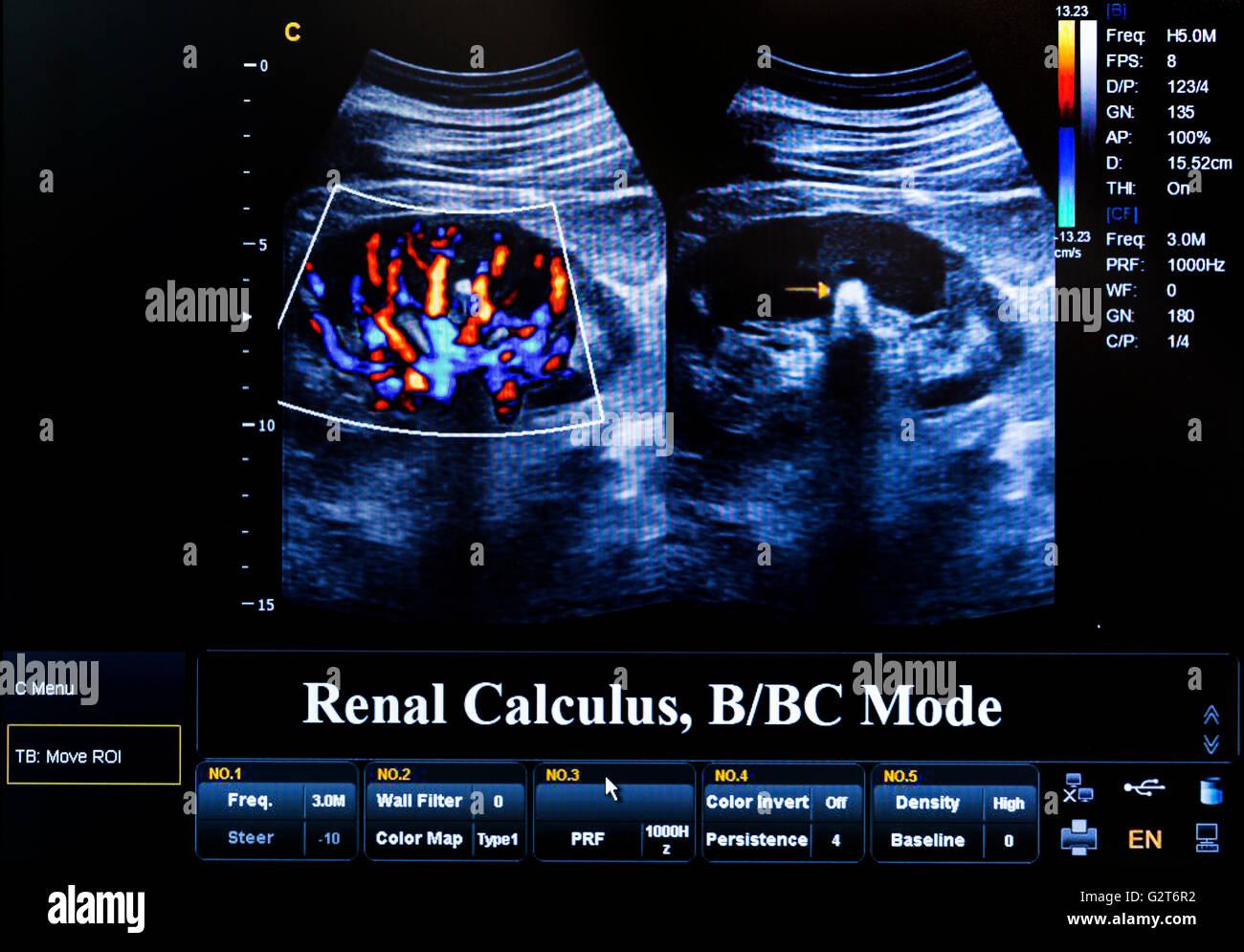 Moderne Echokardiographie (Ultraschall) Maschine Monitor. Farbbild. Neues Hospitl Material. Renal Kalkül. Stockfoto