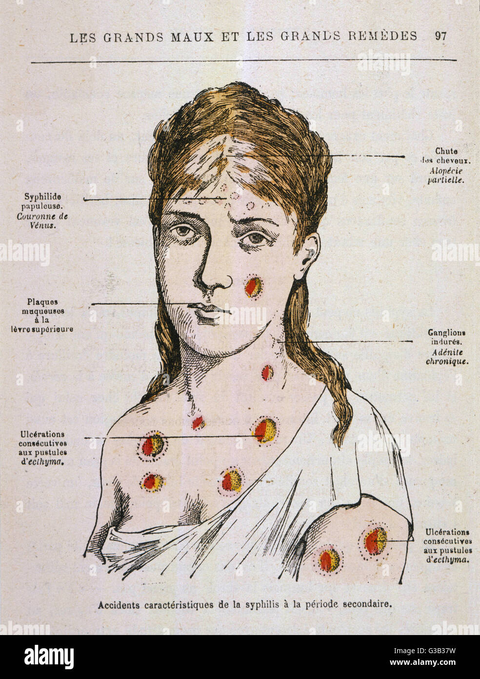 Diagramm den Ausschlag zeigen, die in der zweiten Phase der Syphilis Datum erscheint: 1883 Stockfoto