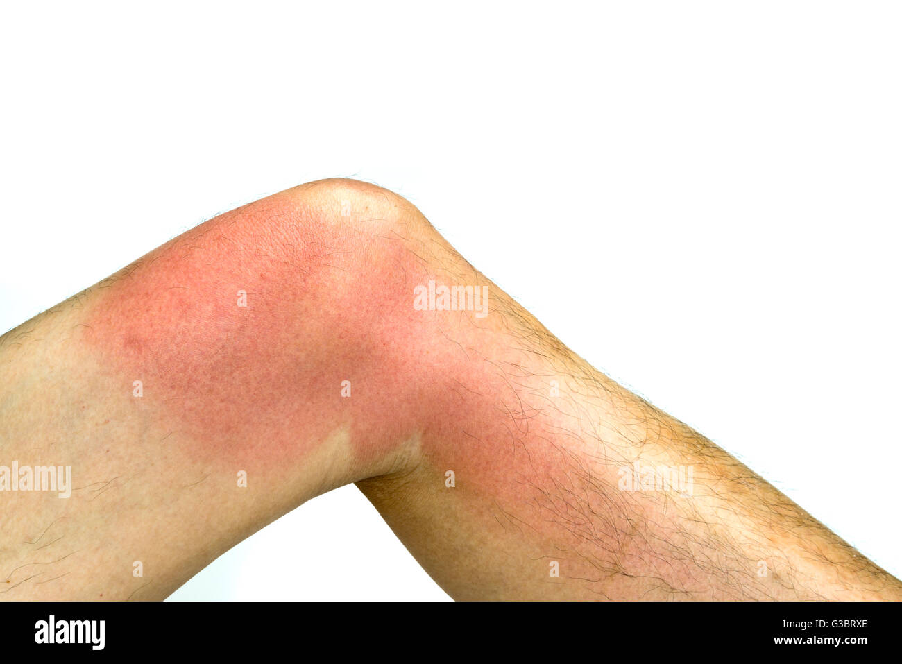 Sonnenbrand auf der Haut rund um die Knie des Mannes linkes Bein, isoliert auf weißem Hintergrund Stockfoto