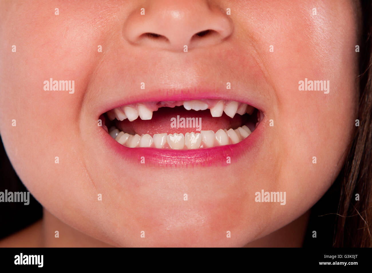 Glücklich, offenem Mund mit fehlenden Zähnen, die Austausch von Milchzahn für Erwachsene Zahn aufwachsen, dental-Konzept. Stockfoto