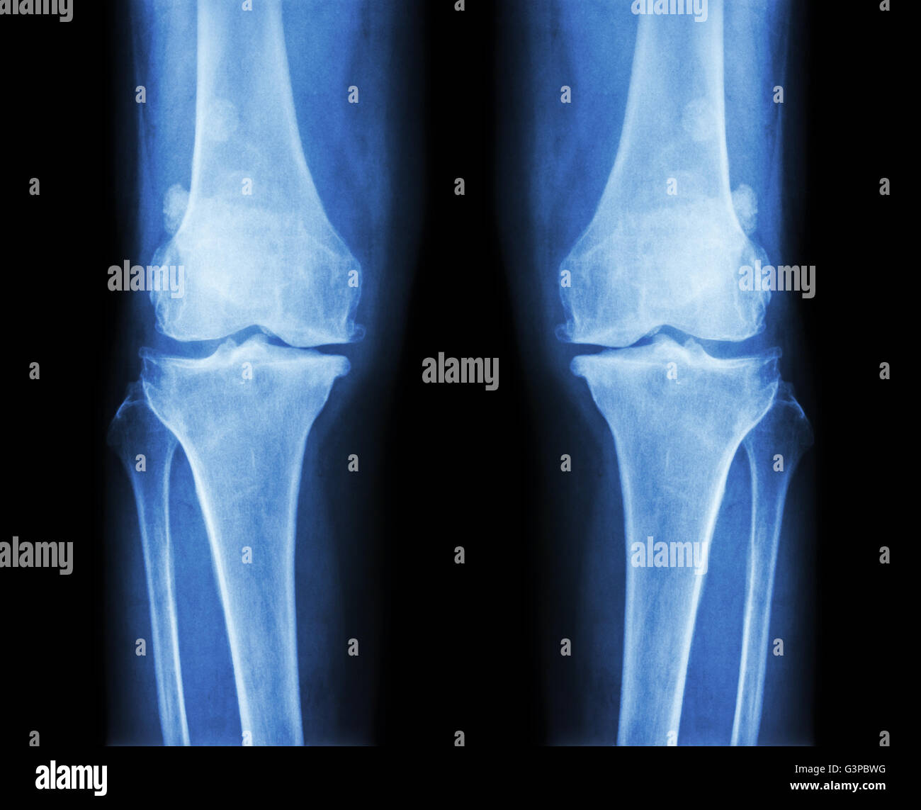 Arthrose, die beide Knie.  Film x-ray AP (anterior - posterior) Knie Show schmaler Gelenkspalt, Osteophyten (Spur), größte Stockfoto