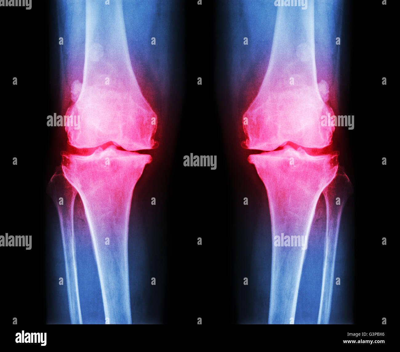 Arthrose, die beide Knie.  Film x-ray AP (anterior - posterior) Knie Show schmaler Gelenkspalt, Osteophyten (Spur), größte Stockfoto
