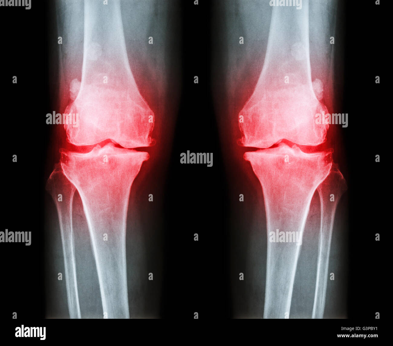 Arthrose, die beide Knie.  Film x-ray AP (anterior - posterior) Knie Show schmaler Gelenkspalt, Osteophyten (Spur), größte Stockfoto