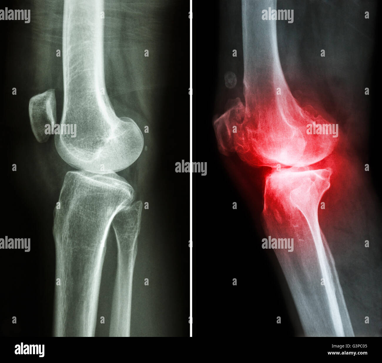 normalen Knie (linkes Bild) und Arthrose Knie (rechtes Bild) (seitliche Ansicht) Stockfoto