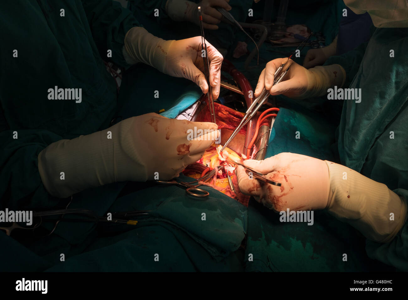 Bentall Operation in aufsteigender Aortenaneurysma Stockfoto