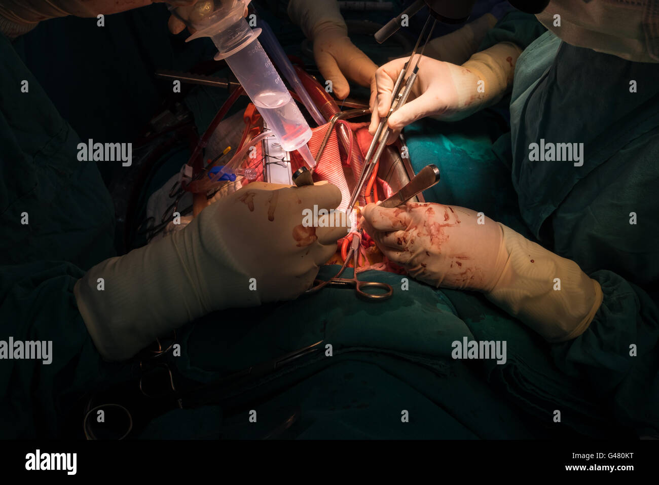 Bentall Operation in aufsteigender Aortenaneurysma Stockfoto