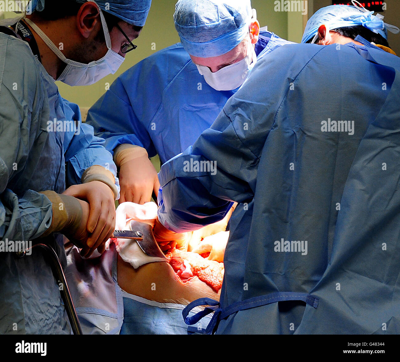 Ein generisches Stock-Foto einer Operation im Queen Elizabeth Hospital, Birmingham. Stockfoto