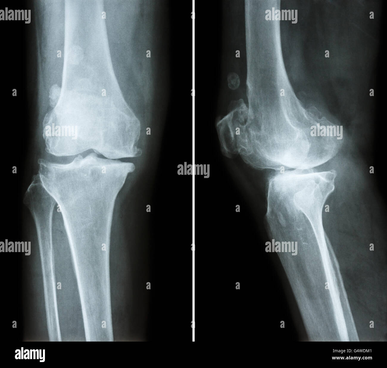Arthrose Knie.  Filmschau Röntgen Knie (anterior - posterior und lateral View) schmale Gelenkspalt, Osteophyten (Spur) Stockfoto