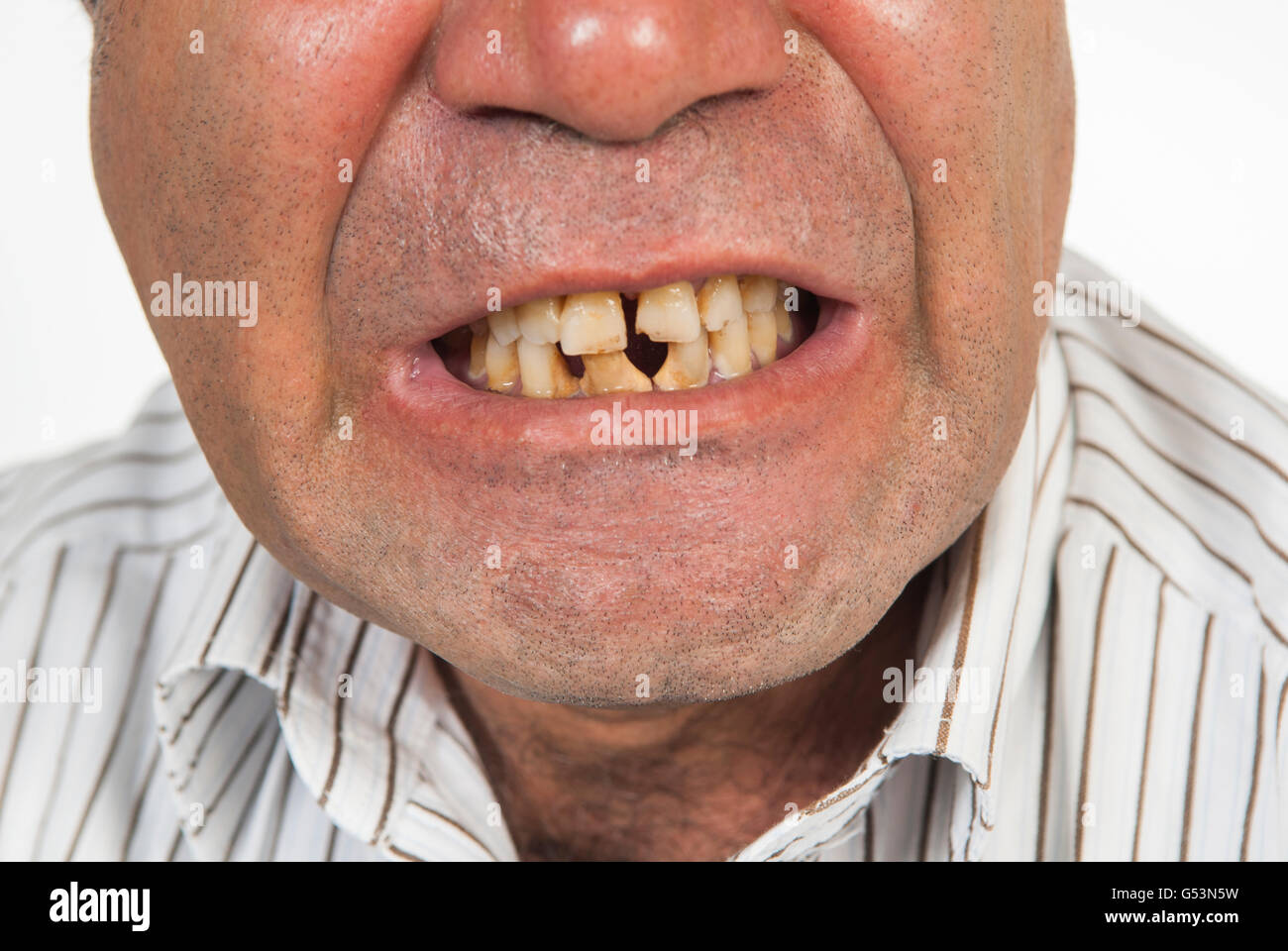 Verärgerter Mann mit schlechten Zähnen Stockfoto