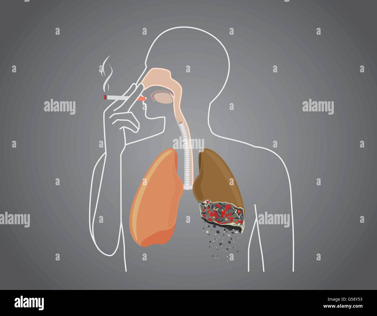 Menschen mit dem Rauchen Lunge brannte Stock Vektor
