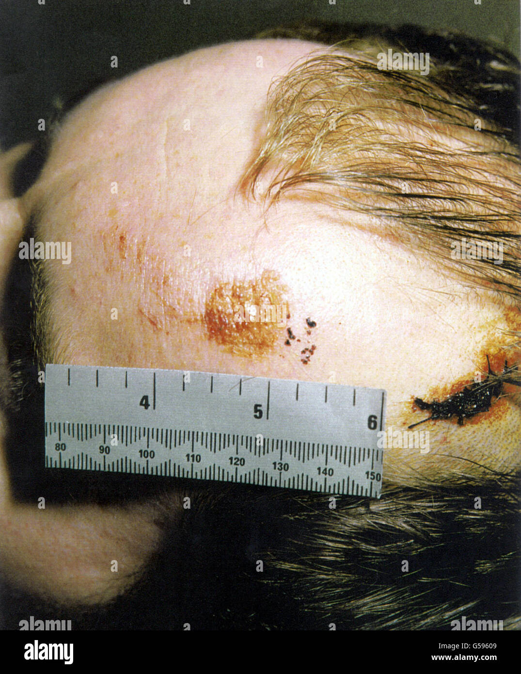 Verletzungen von ehemaligen IRA-Gefangenen Stockfoto