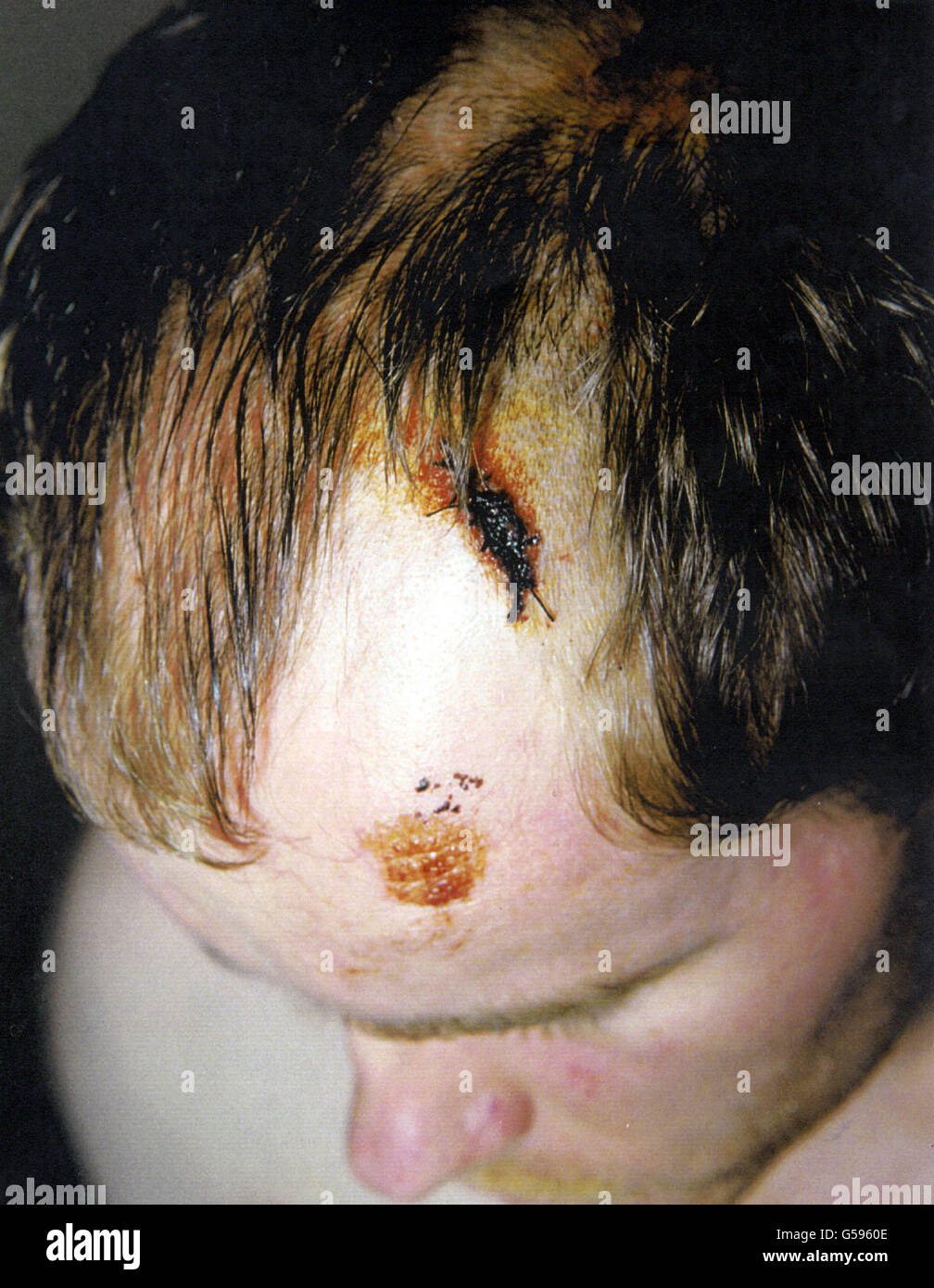 Unsiccessful Ausbruch Verletzungen Stockfoto