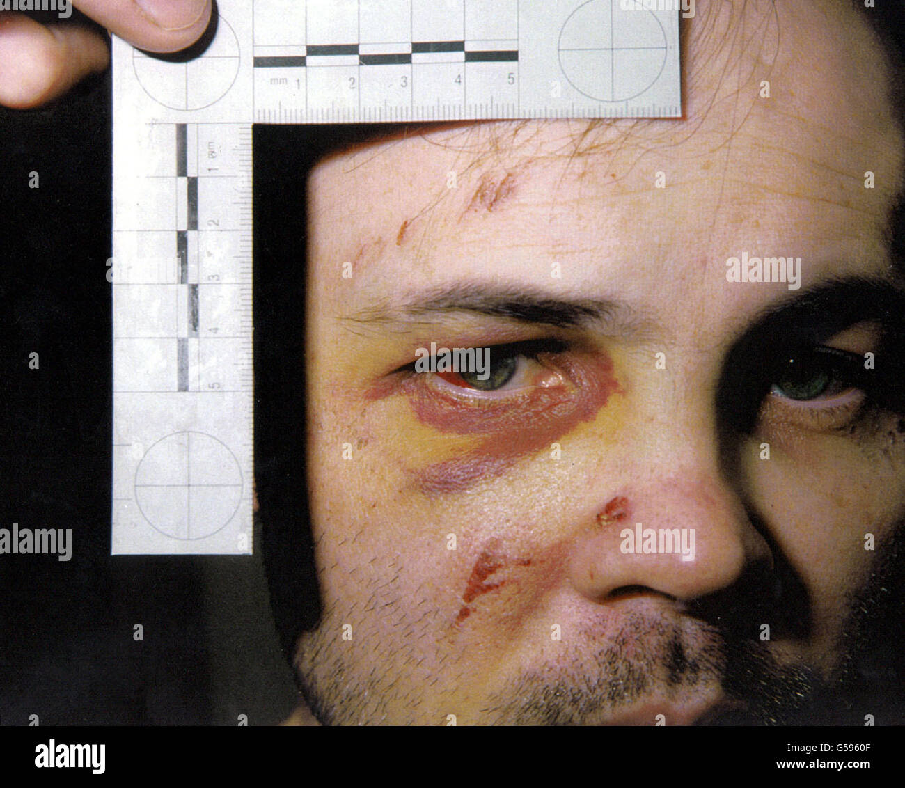 Verletzungen von ehemaligen IRA-Gefangenen Stockfoto