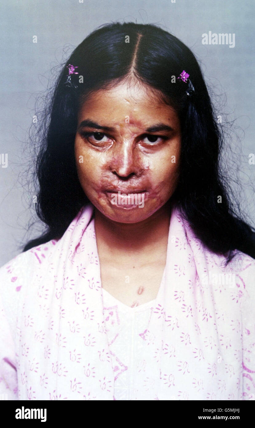 Blair Indien besuchen Säure-Opfer Stockfoto