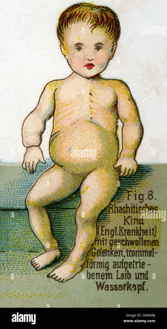 Medizin, Krankheiten, Rachitis, aus: Friedrich Eduard Bilz, Neue Naturheilkunde, Leipzig, Deutschland, 1902, zusätzliche-Rechte-Clearenzen-nicht verfügbar Stockfoto