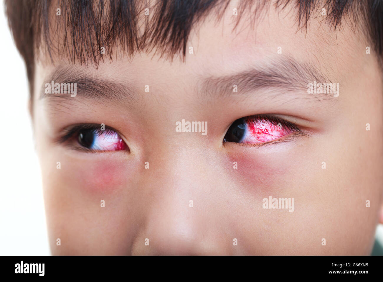 Nahaufnahme der chronischen Konjunktivitis mit roter Iris. Geringe Schärfentiefe (Dof), linke Auge des asiatischen Kind im Fokus. Stockfoto