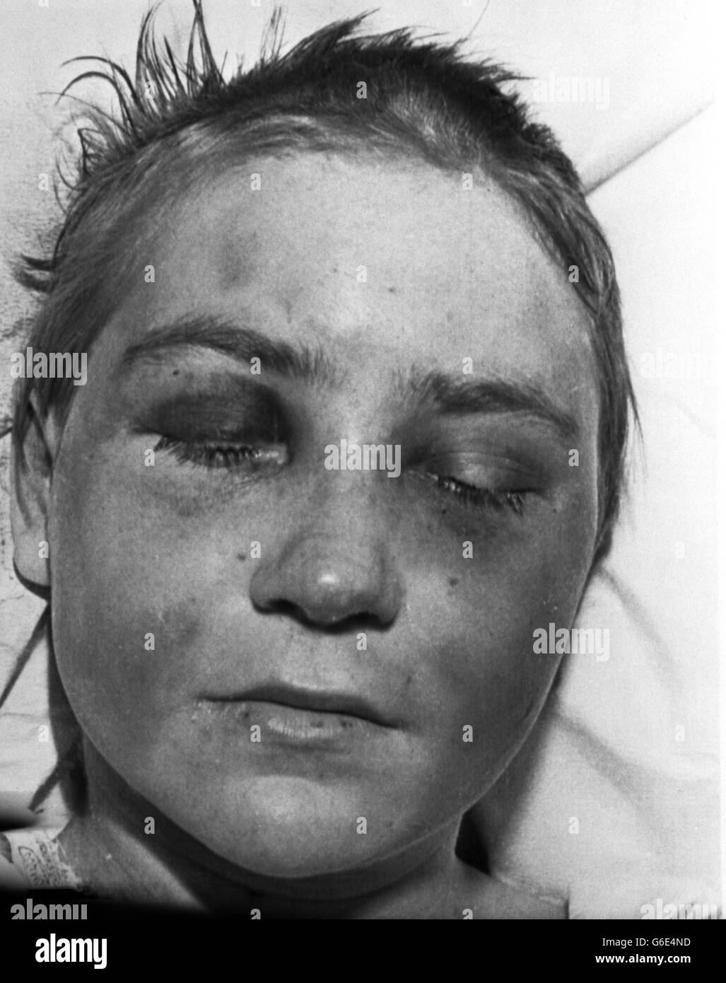 Elizabeth Hylands, 15, liegt in einem Krankenhaus in Belfast, nachdem sie von der offiziellen IRA geteert, gefiedert und geschlagen wurde. Stockfoto