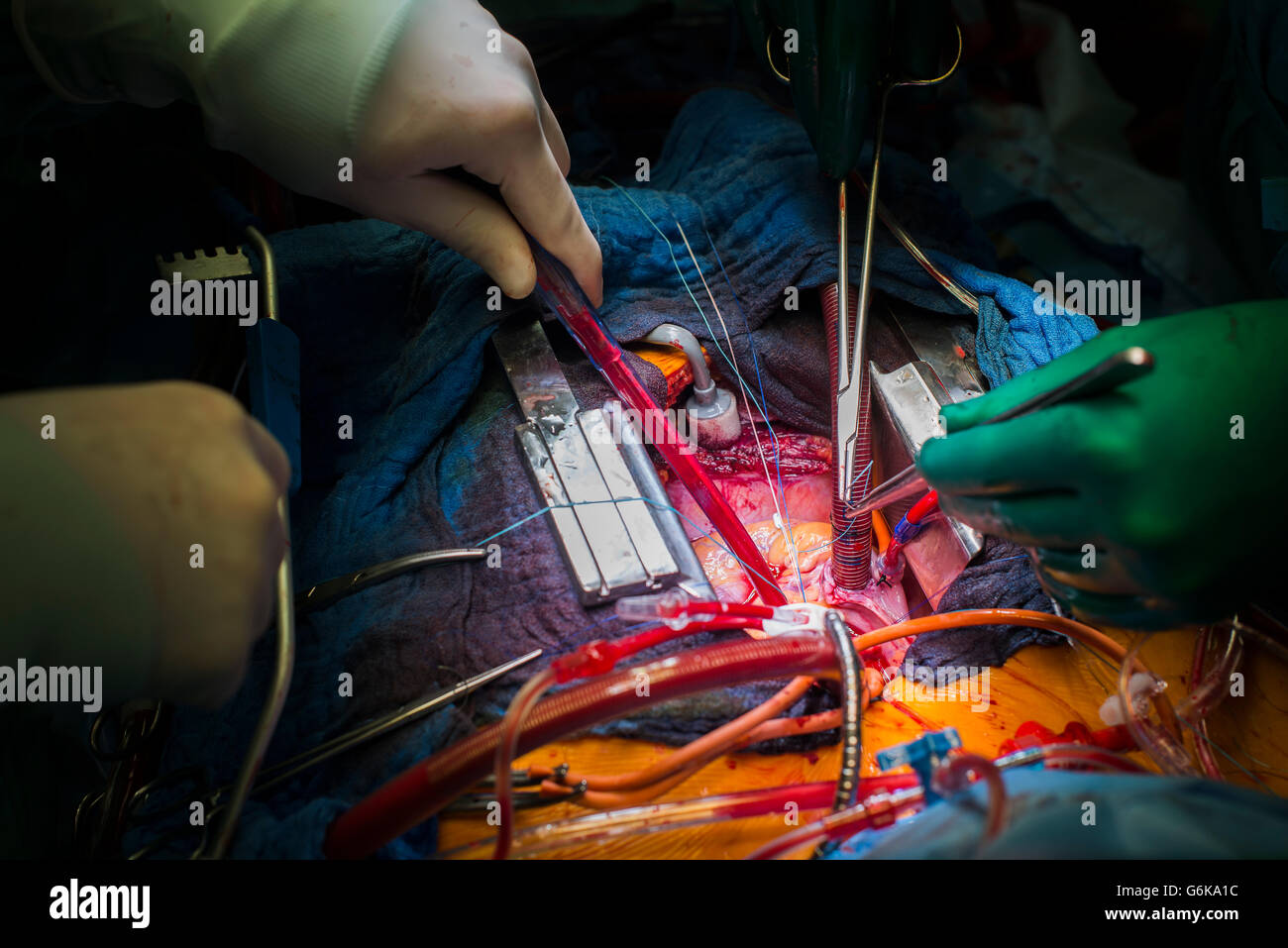 Herzoperation Stockfoto