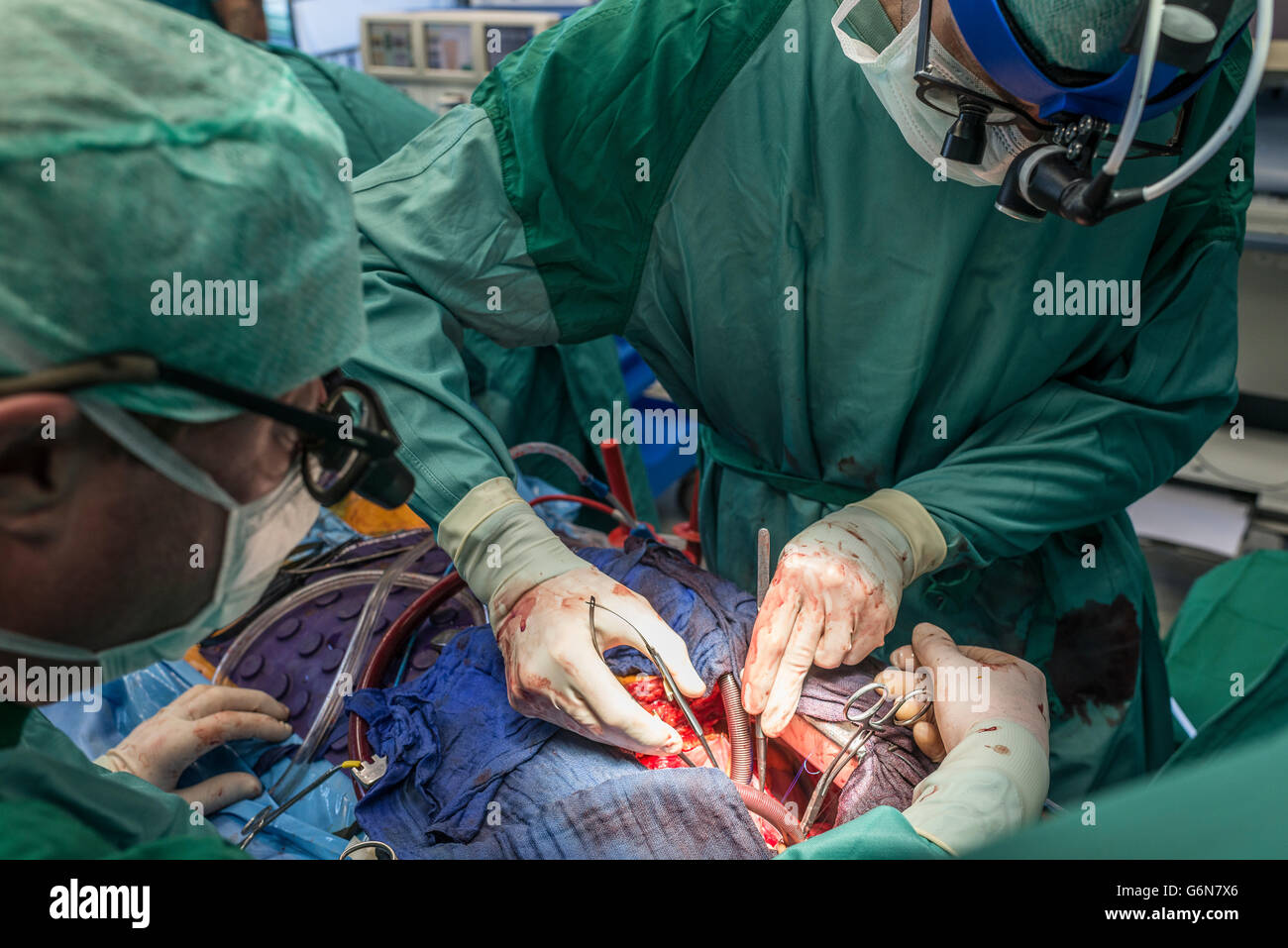 Chirurgen, die Ausführung von Herz-bypass-Operation Stockfoto