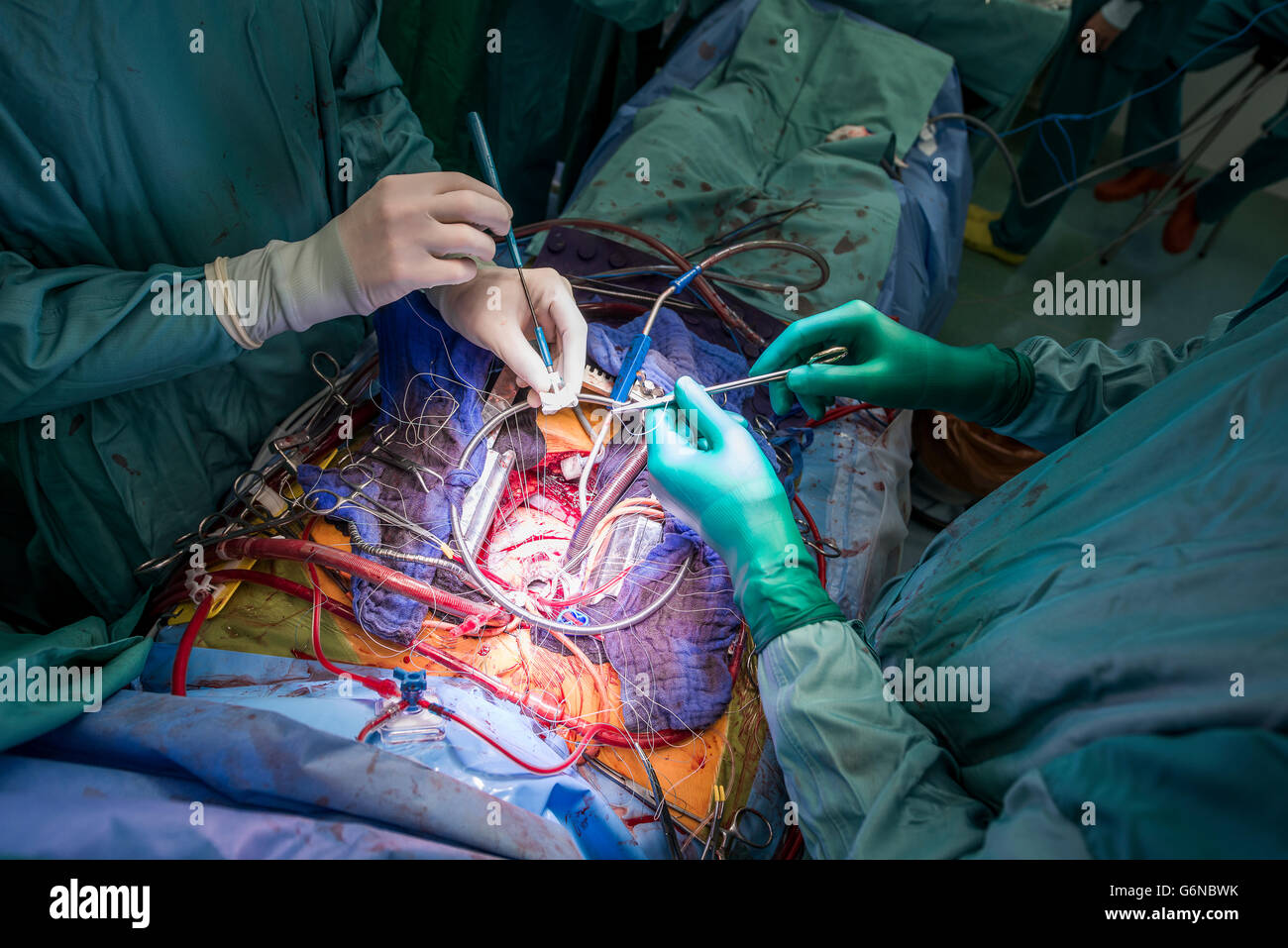Herzchirurgen während einer Herzoperation Stockfoto