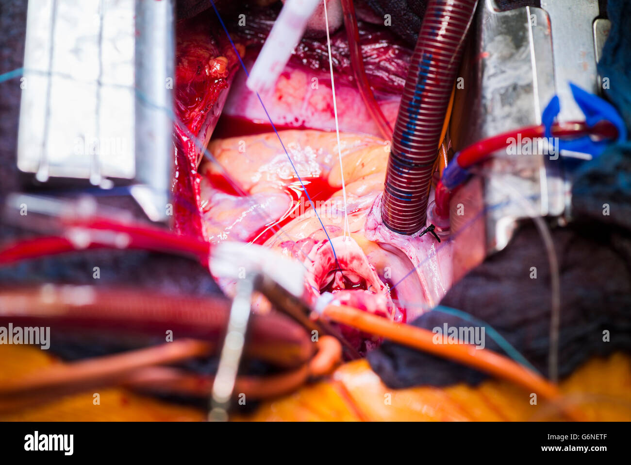 Herzoperation Stockfoto